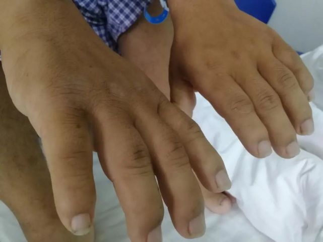 手指肿的像鼓槌,小心"杵状指"!