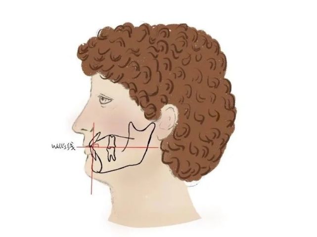 h线1983年holdaway提出,h线是指通过颏前点与上唇相切的线,侧面貌理想
