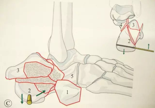 将剥离子插入跟骨结节骨块和载距突骨块之间,向下