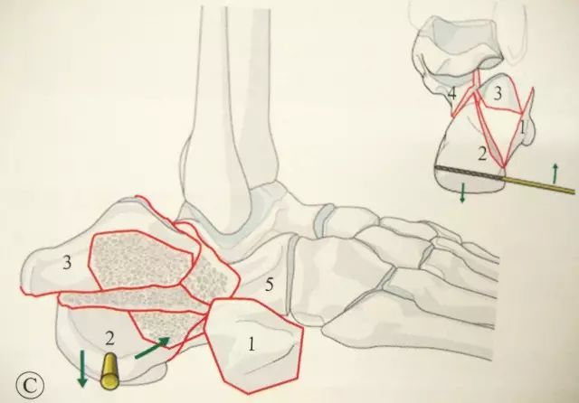 是首先回复跟骨结节骨块(2)同载距突骨块(4)的位置关系,回复跟骨的