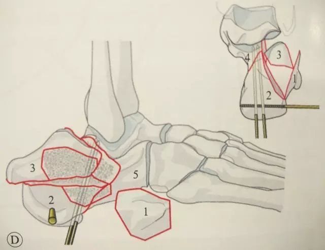 牵引恢复跟骨长度,纠正内翻畸形将剥离子插入跟骨结节骨块和载距突骨