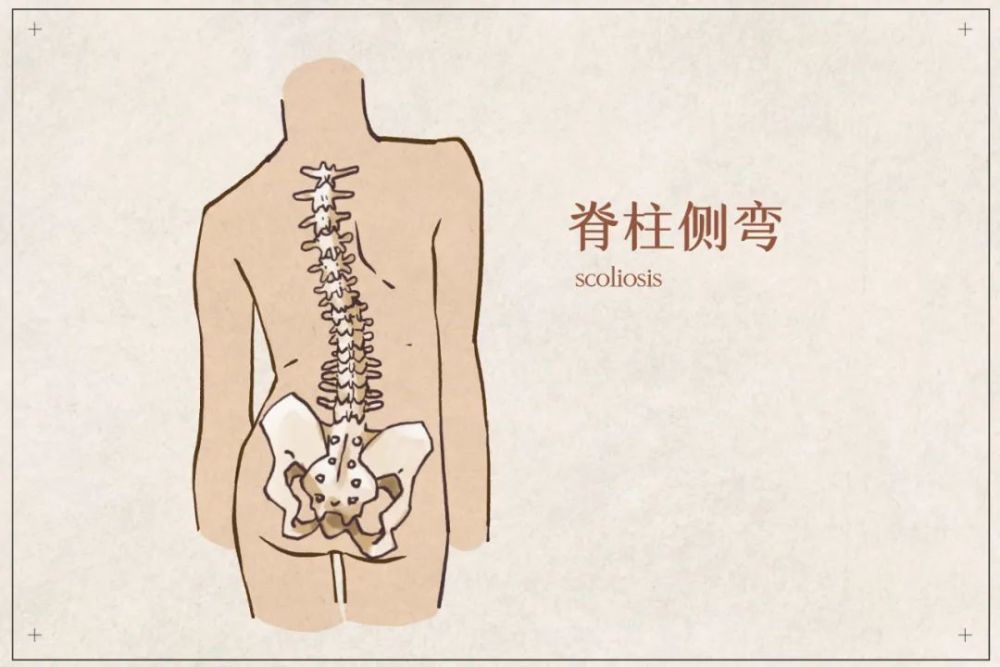 每6个孩子就有一个脊柱侧弯只因10岁前家长忽略了这一点90父母都不
