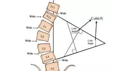 如图: 下图cobb角是衡量脊柱侧弯的标准,cobb角大于10度就可以诊断