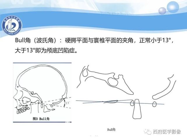 颅底凹陷症的影像诊断与鉴别诊断