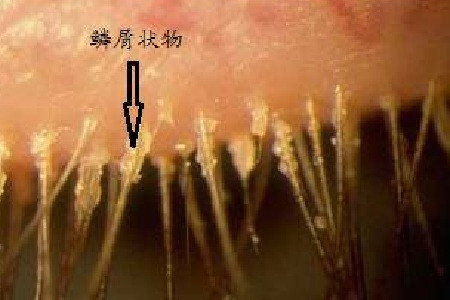 所引起;鳞屑性睑缘炎一般是由于局部腺体分泌过多而导致的湿疹性皮炎