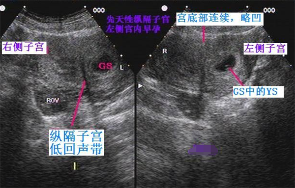 什么是纵膈子宫纵膈子宫对怀孕有哪些影响