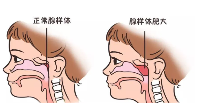 孩子鼾声如雷慢慢变丑是腺样体肥大在作怪