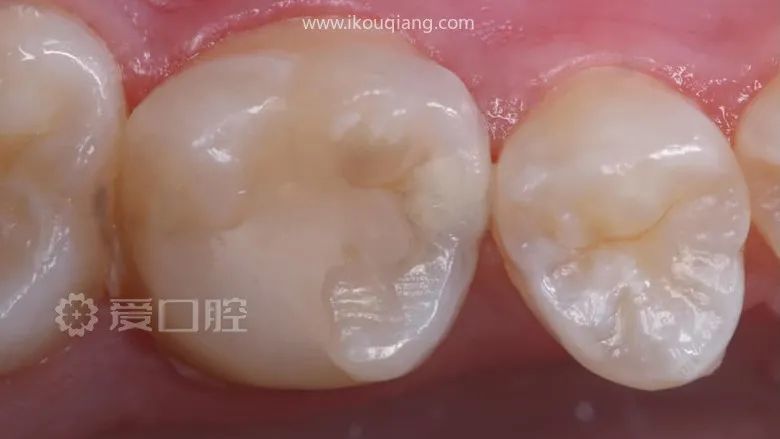 往期推荐上颌3-3贴面修复1例上颌第一磨牙根管再治疗1例补牙也是门