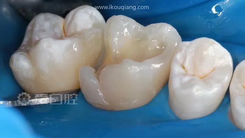 往期推荐上颌3-3贴面修复1例上颌第一磨牙根管再治疗1例补牙也是门