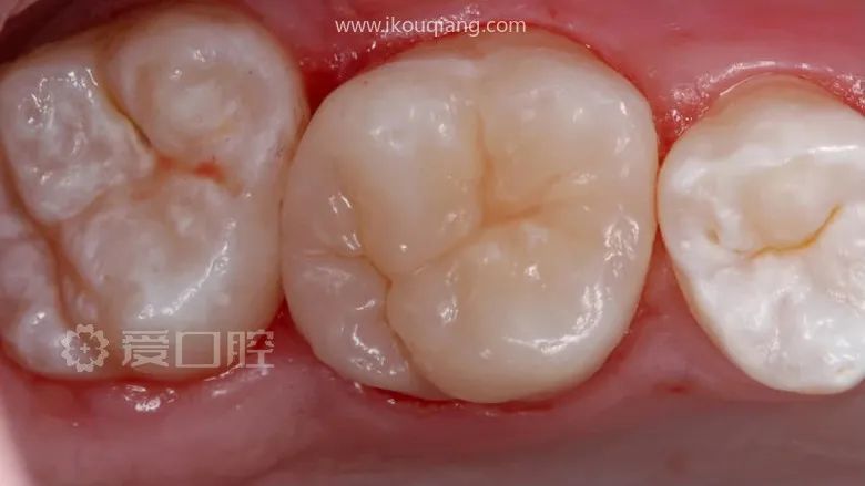 17组补牙前后照欣赏(第2期)真的很漂亮,上前牙树脂分层充填美学欣赏