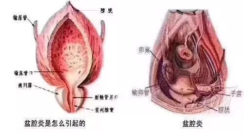 每日小知识:什么是盆腔积液