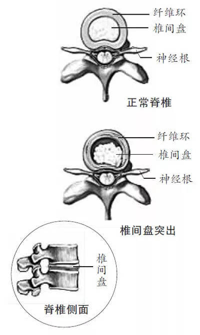 腰椎间盘同志你太突出了给上班族的你7条建议远离腰椎间盘突出