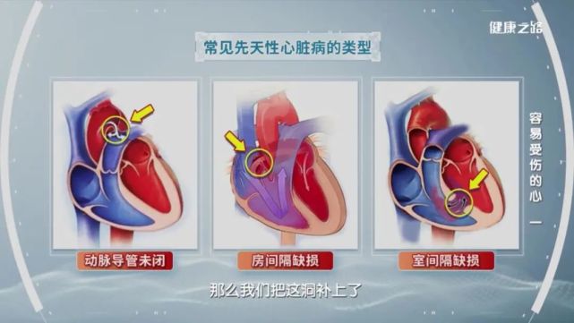 常见先天性心脏病类型