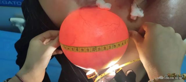 你的身体变胖,除了体内脂肪膨胀外,皮肤也会长,以至于当你瘦下来后
