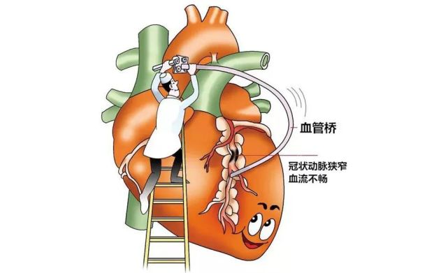 心脏搭桥手术心脏支架手术很多人搞混到底哪个好