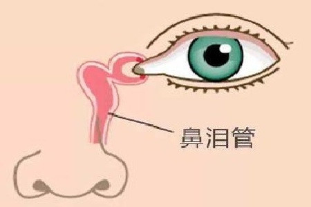 鼻泪管狭窄,阻塞的原因有哪些