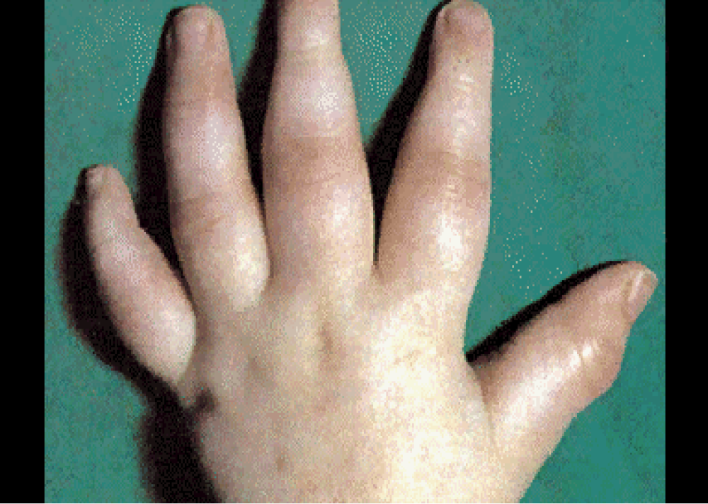 中晚期ra患者会出现关节畸形变:如双手关节尺偏畸形,鹅颈样变,扭花样