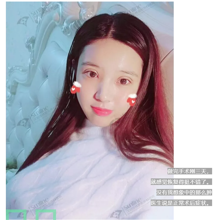 张莹莹双眼皮案例杏林整形张莹莹怎么样