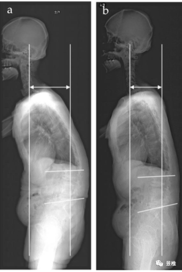 手术技巧|凿掉棘突改善胸腰段后凸