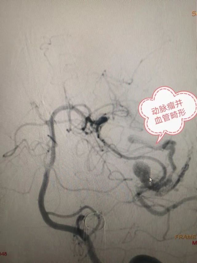 造影结果显示脑血管畸形合并动脉瘤介入科为瑶瑶进行了脑血管造影