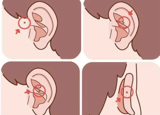 在医学上,这种小洞叫作"先天性耳前瘘管",是一种最常见的先天性外耳