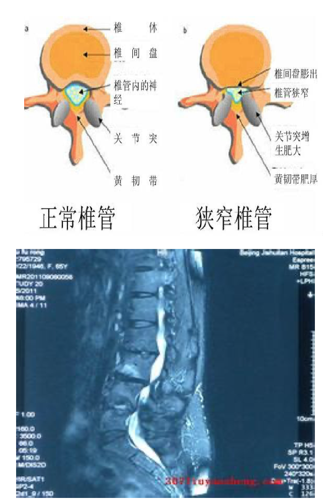 腰椎间盘突出症一几种常见的腰痛疾病隐性脊椎裂,脊柱侧凸,后凸脊膜