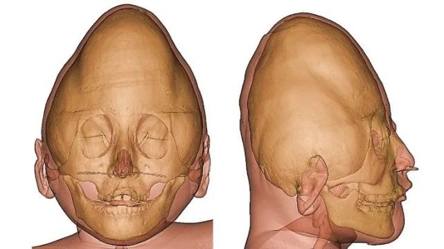 【热点】首儿所神经外科成功为"奥特曼"女孩进行颅骨外形重建手术