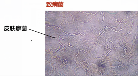 以红色毛癣菌最为多见,其他如犬小孢子菌,须癣毛癣菌等也可引起本病