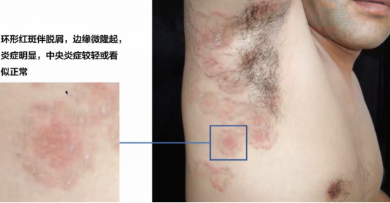 皮肤的不速之客——真菌暗袭,体癣缠身