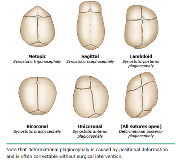 不同颅缝提早闭合导致头型异常的不同形态:图片来源:uptodate颅缝
