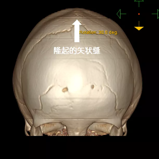 儿科纪实一个颅缝早闭孩子的治愈故事