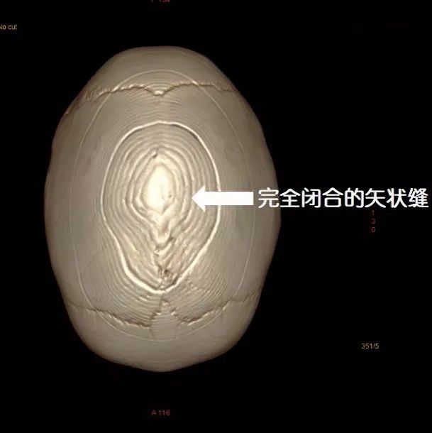隆起的矢状缝完全闭合的矢状缝从孩子妈妈发给我的照片外观看,术后