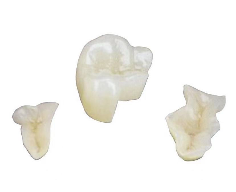 嵌体是一种嵌入牙体内部,用以恢复牙体缺损的形态和功能的修复体.