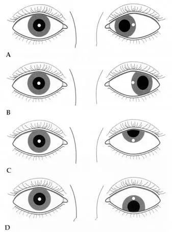 也很多,内斜,外斜,调节性斜视,非调节性斜视,共同性斜视,麻痹性斜视