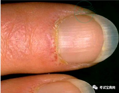 特发性炎症性肌病