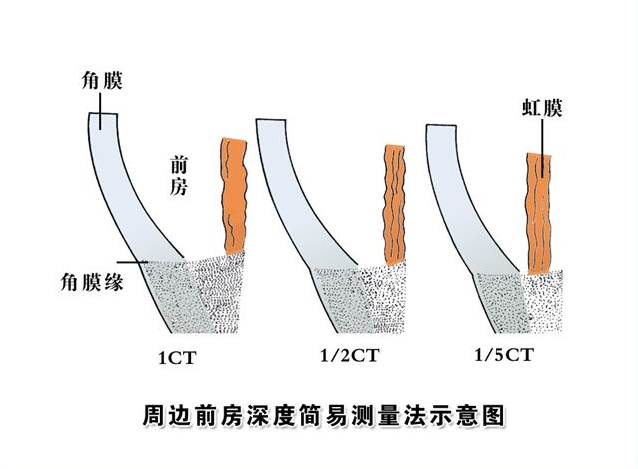 只要前房深度小于28mm就一定不能做晶体植入手术