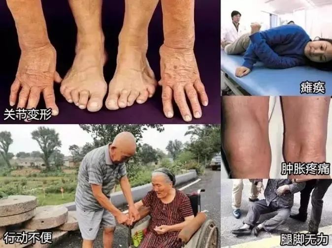 人老腿先衰护腿先护膝做好一件事年老时少受罪