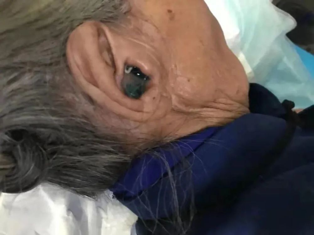 女子总是耳朵疼,医生一看:20条活蛆啊!