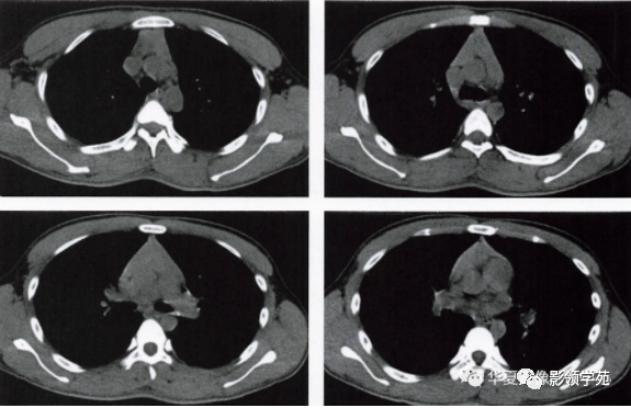 胸腺增生的影像诊断