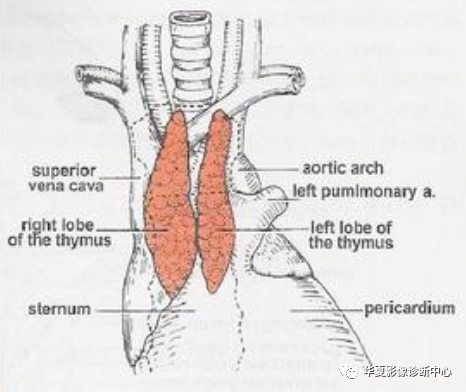 胸腺增生的影像诊断