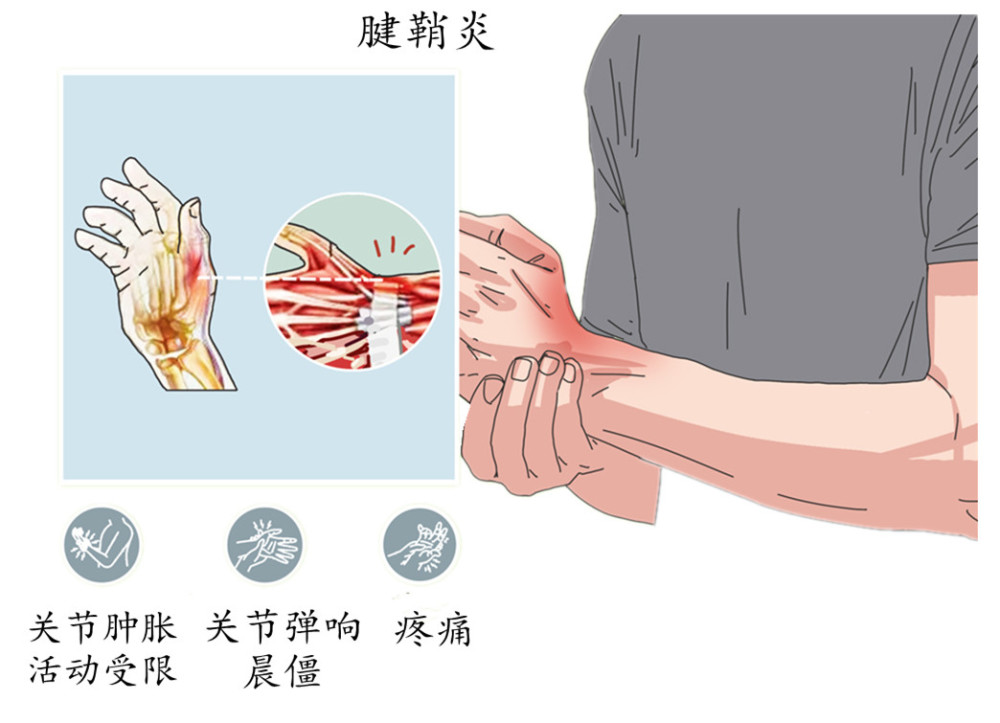 如早期的腱鞘炎有一种典型的症状叫"弹响指,即起病初期在手指屈伸时