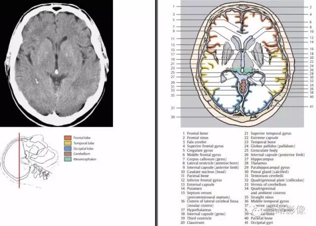 【收藏】史上最全的ct断层解剖图谱【内容有点长,但很全|ct|侧脑室