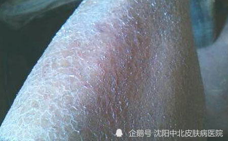 银屑病和鱼鳞病的症状图片有哪些