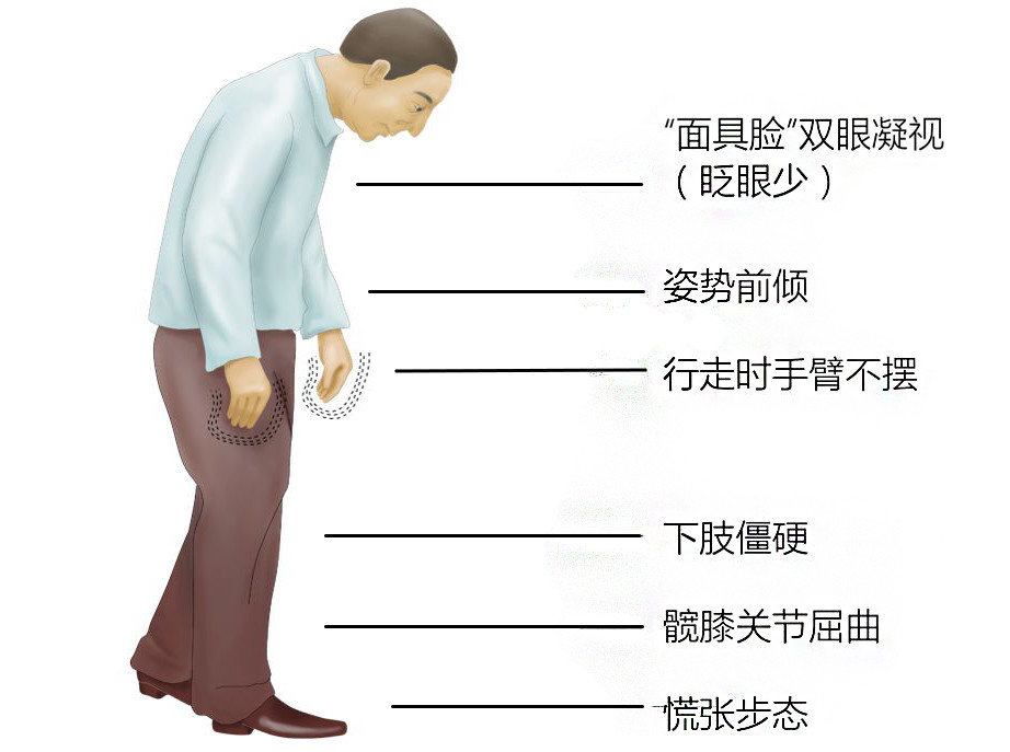 广州和谐医院神经修复医学中心为您科普帕金森患病原因与类型