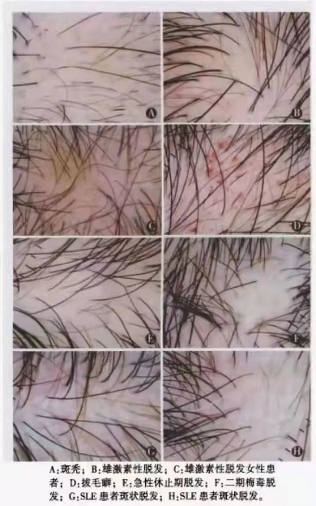头发油腻有头皮屑哪个才是脂溢性脱发的标志