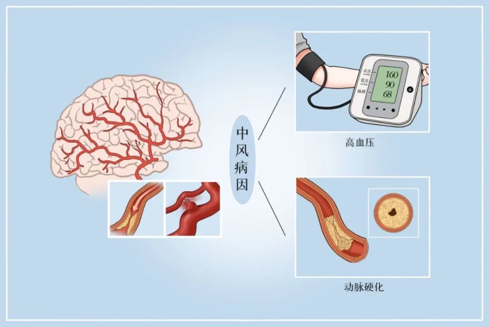 脑卒中 所谓"防,是要积极发现和控制危险因素.过去30年