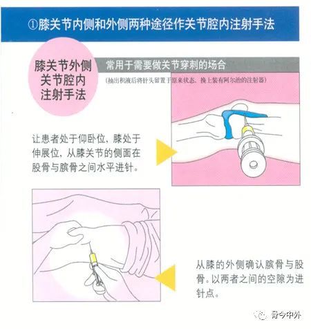 关节腔内注射空气或造影剂,行关节造影术,以了解关节软骨或骨端的变化