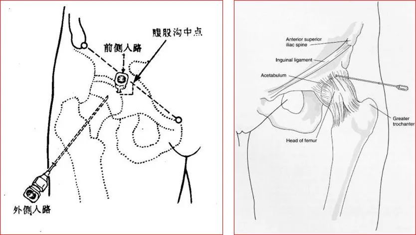 12种关节腔穿刺方法,你都掌握了吗?