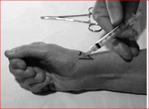 12种关节腔穿刺方法你都掌握了吗