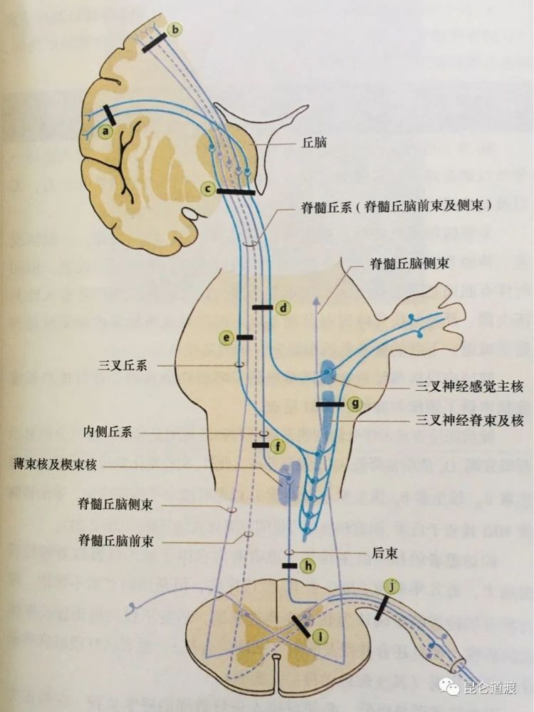 5,若病变累及内侧丘系和脊髓丘脑前束(f),则对侧偏身除痛觉和温度觉以